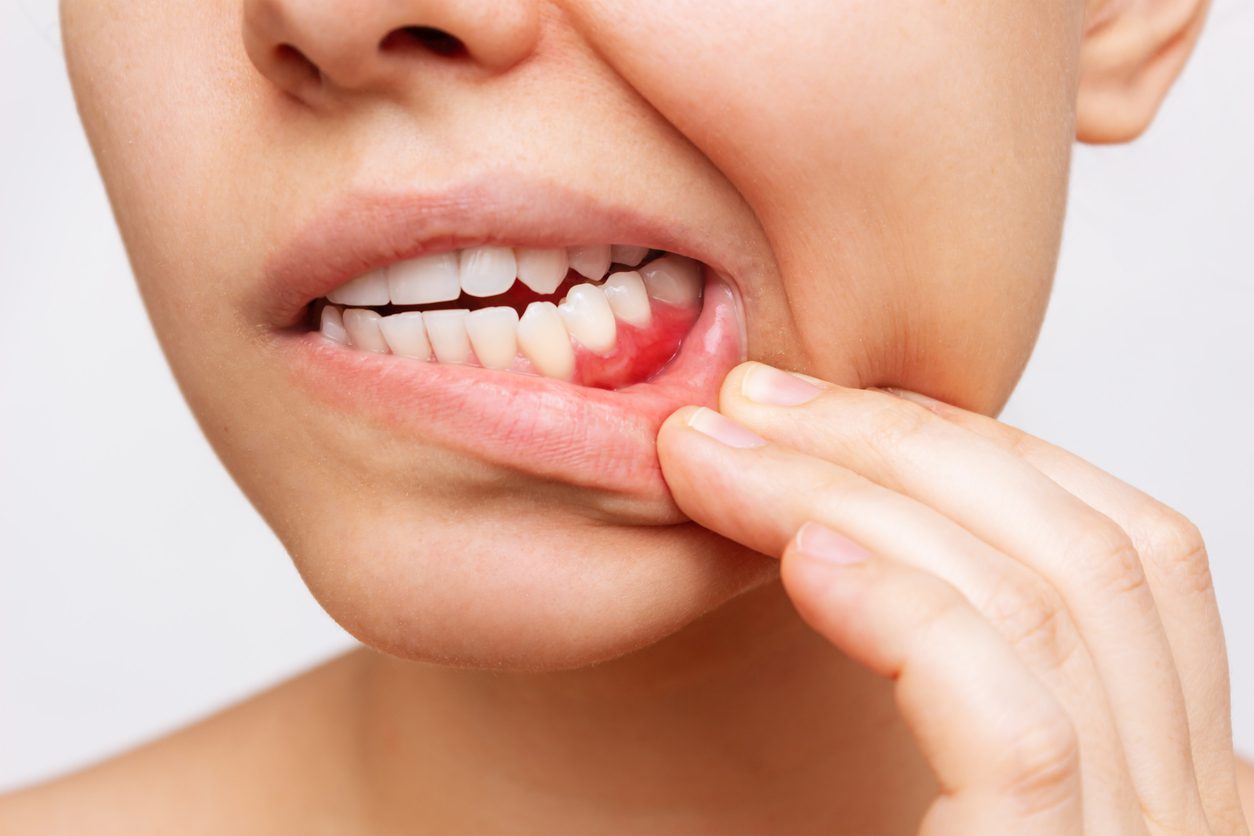 Gingivitis